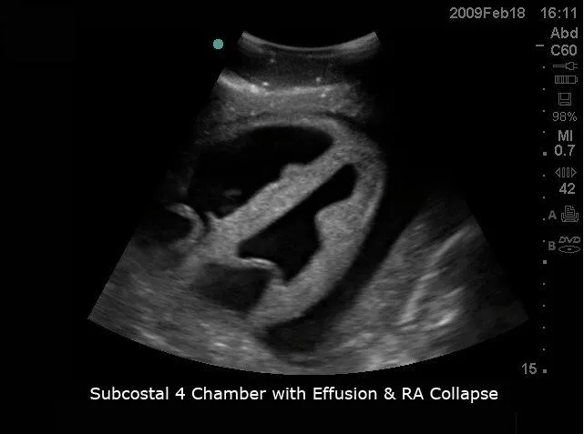 Transesophageal Echo and Transthoracic Echo Training Model